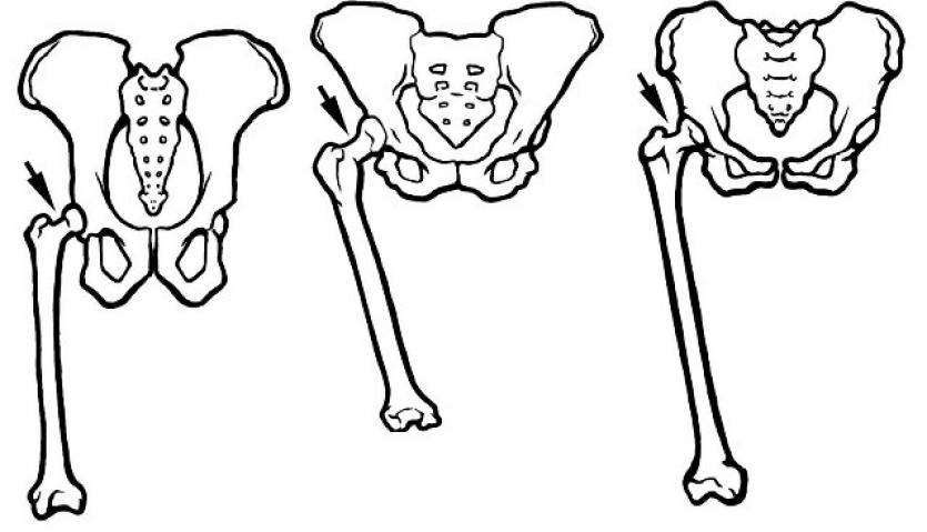Pelvis Comparison